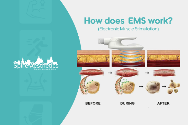 EMS treatment for post pregnancy weight loss treatment Dunfermline