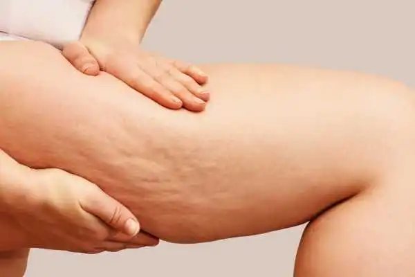 Image of woman showing leg with cellulite Dunfermline