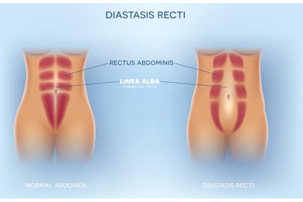 What Non-Surgical Options Are Available for Diastasis Recti Dunfermline?