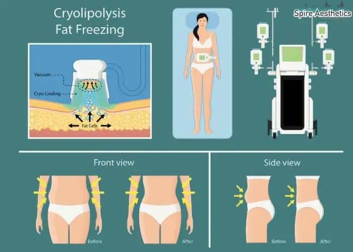 Fat freezing treatment Dunfermline benefits for competitions to remove stubborn fat deposits.
