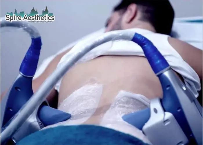 Man having fat freezing treatment done on love handles before a competitions Dunfermline to create a sculpted look.