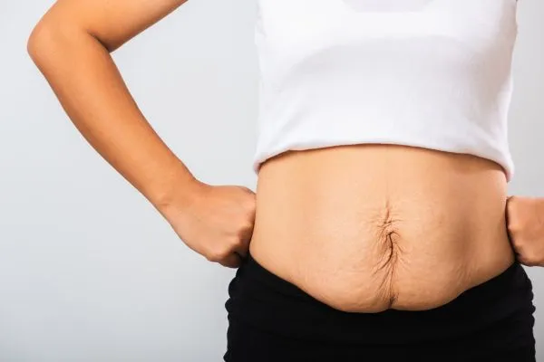Image of a woman's stomach after weight loss with sagging skin following a gastric band Dunfermline