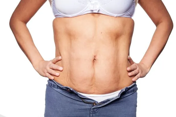 sagging skin on woman's stomach after weight loss injections Dunfermline