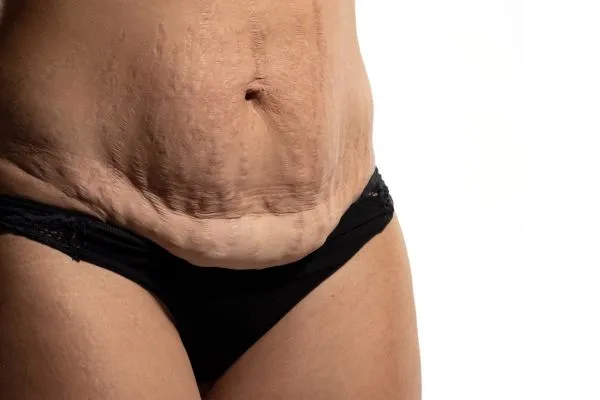 Image of womans stomach after weight loss injections Dunfermline showing saggy skin