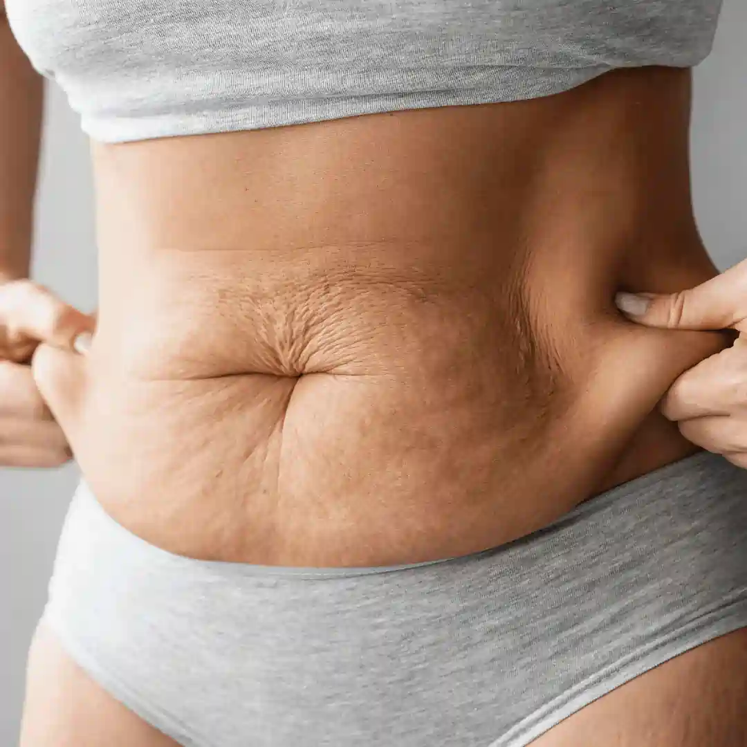 Is It Normal to Have Loose Skin After Pregnancy Dunfermline?